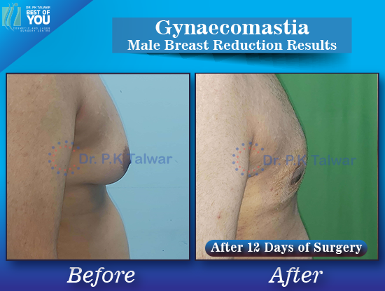 Gynaecomastia before after image